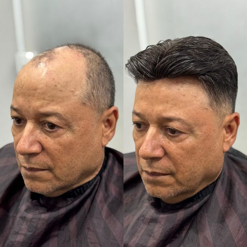 Resultado natural de prótese capilar cobrindo a linha frontal