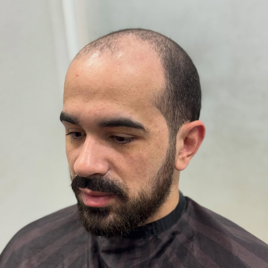 Antes da prótese capilar - frente