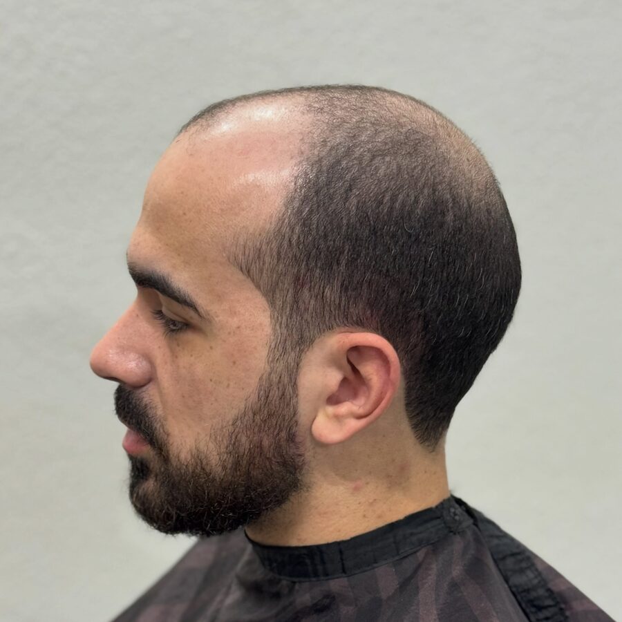 Antes da prótese capilar - lado
