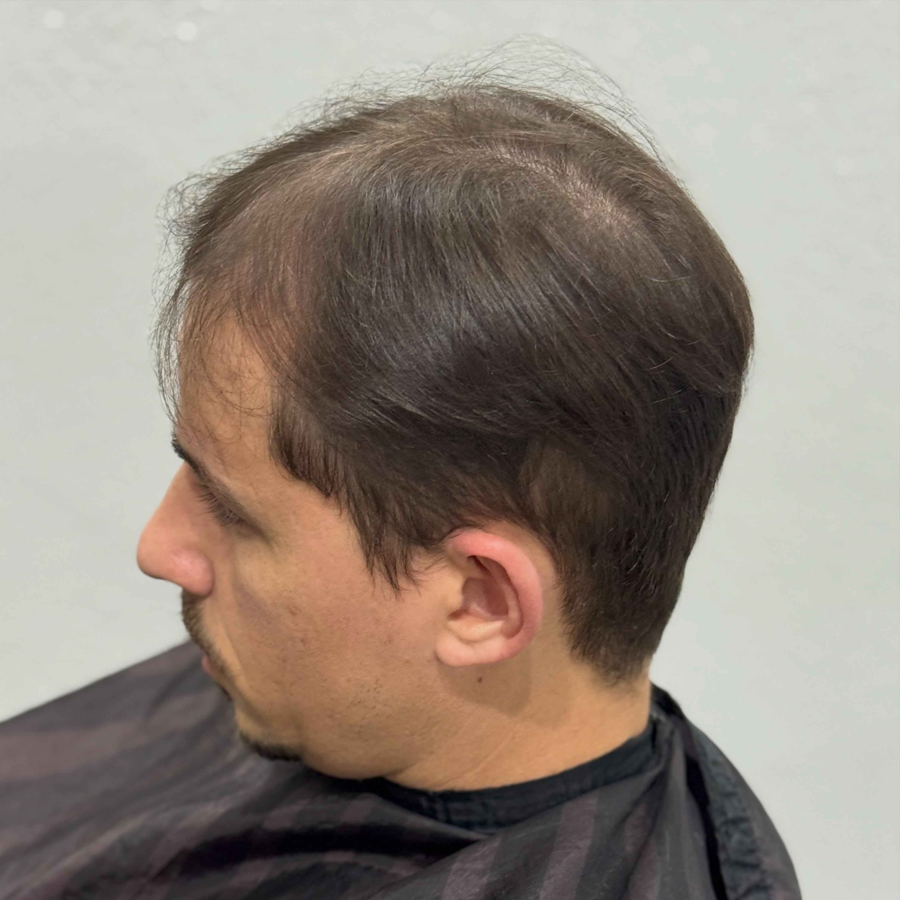 Homem avaliando queda de cabelo intensa e calvície