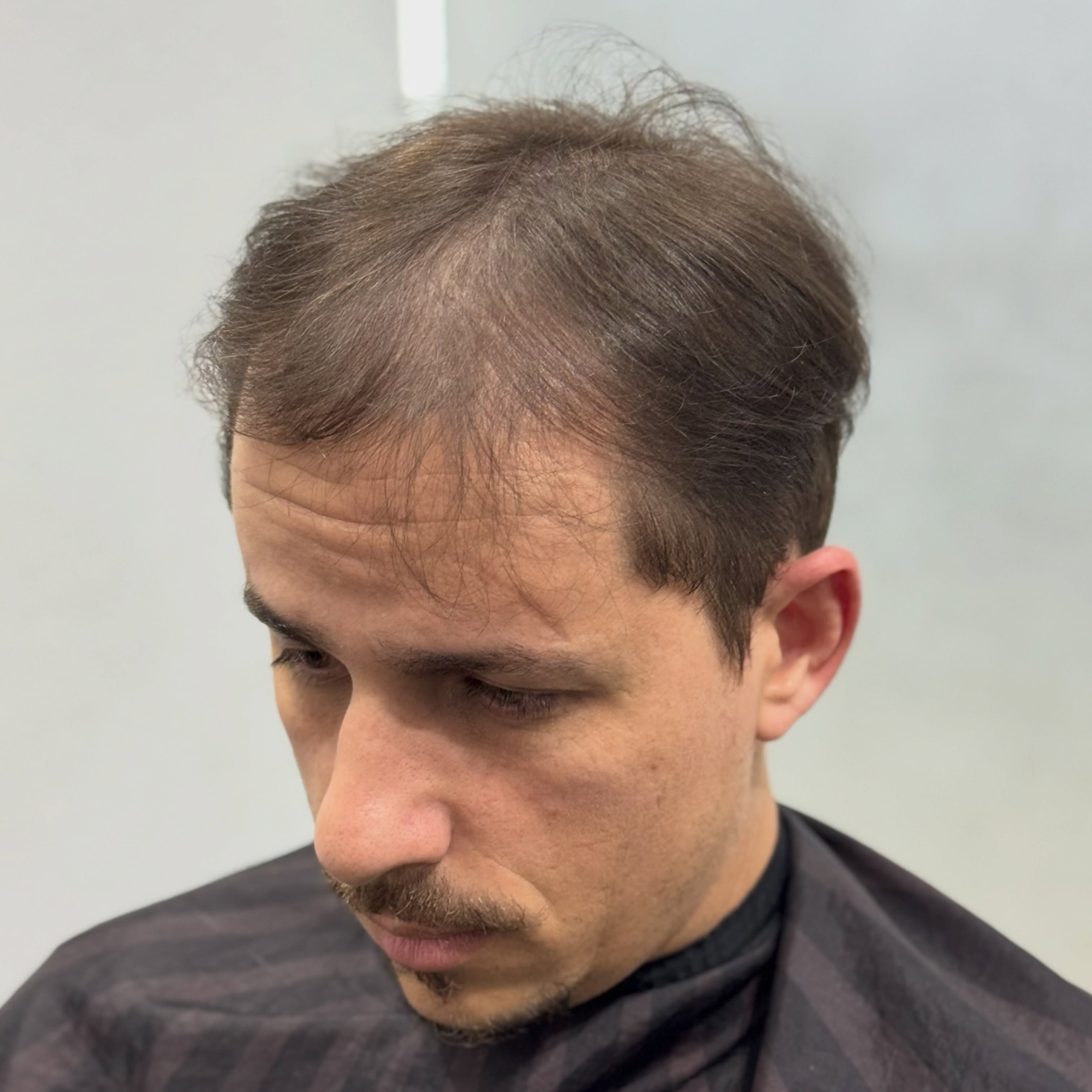 Vista superior de homem avaliando a coroa e o topo da cabeça com queda de cabelo