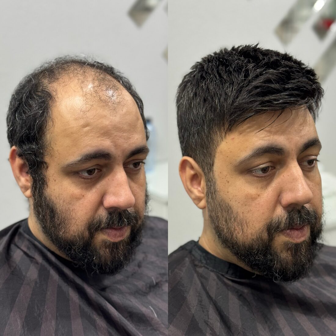 Antes e depois de prótese capilar masculina - transformação completa