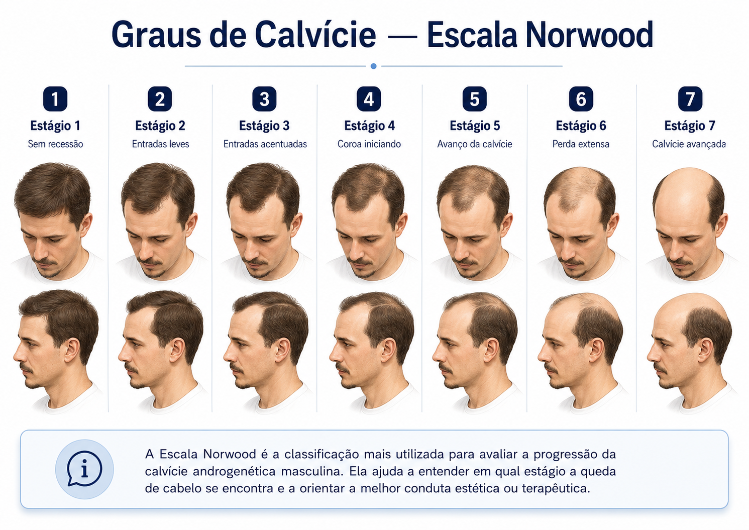 Infográfico com os 7 estágios da Escala Norwood de graus de calvície
