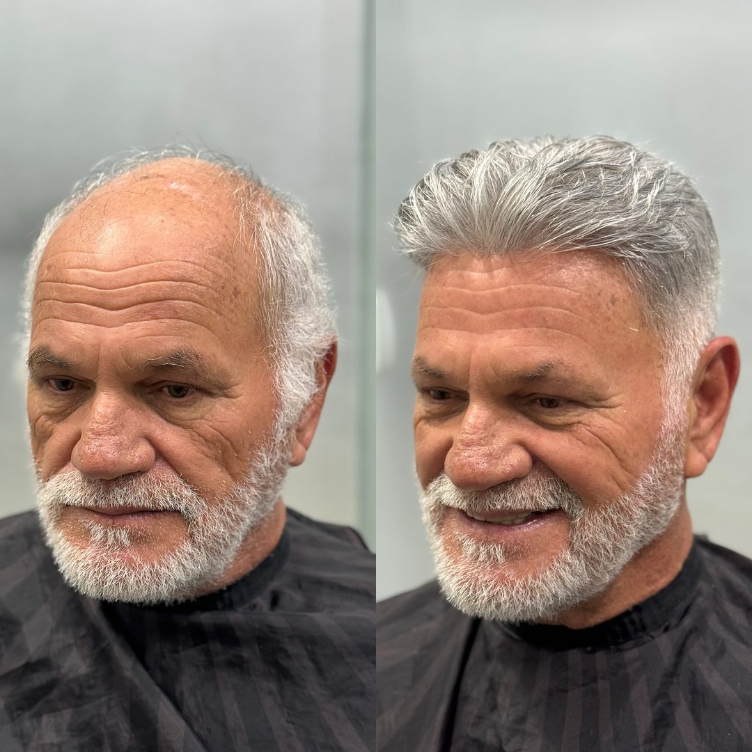 Cabelo grisalho ou calvície - antes e depois