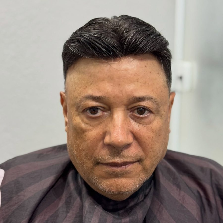 Desvantagens da prótese capilar