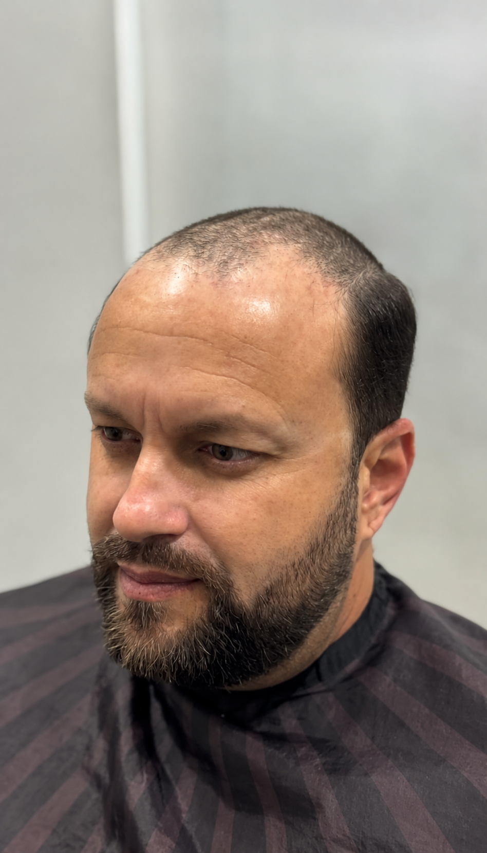Homem avaliando tratamento para calvície