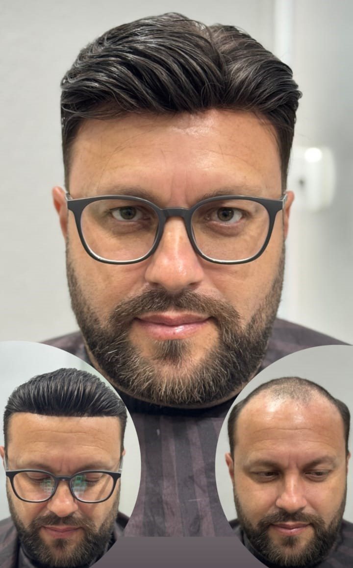 Prótese capilar mal colocada x resultado natural