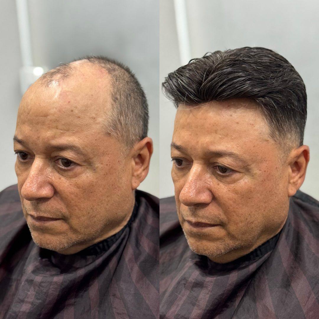 Transformação com prótese capilar masculina - antes e depois
