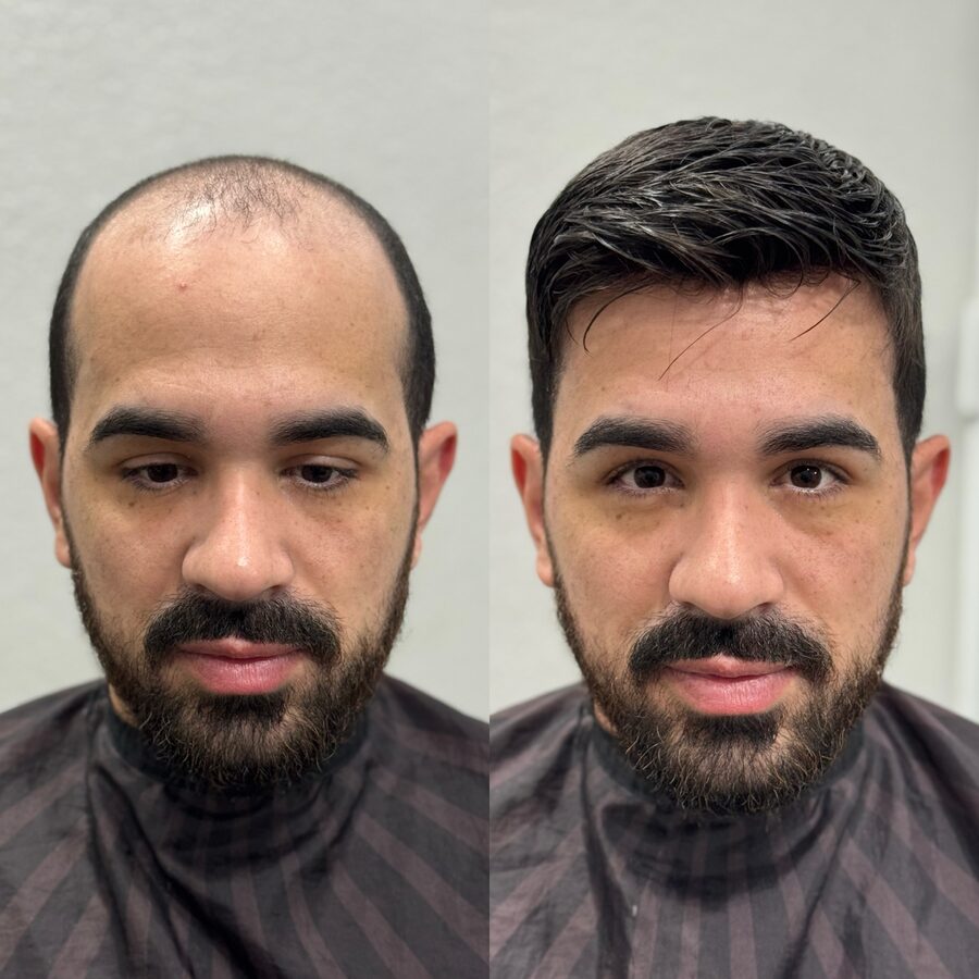 Prótese capilar masculina de alta qualidade