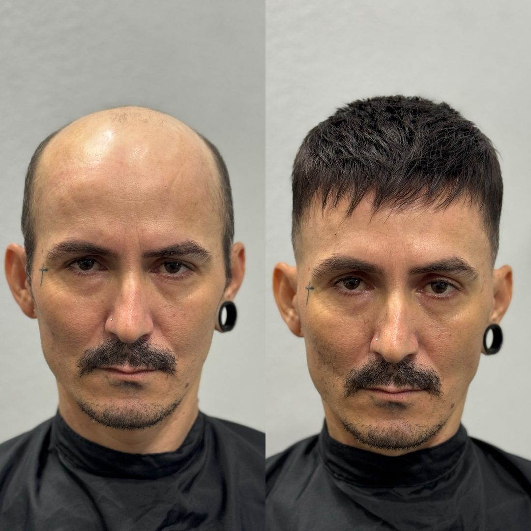 Transformação com prótese capilar masculina de micropele